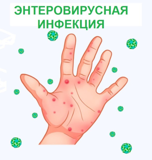 Энтеровирусная инфекция (ЭВИ) Энтеровирусная инфекция (ЭВИ).